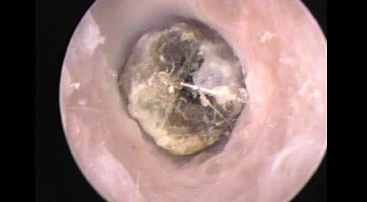 Ceruminolith inside ear canal
