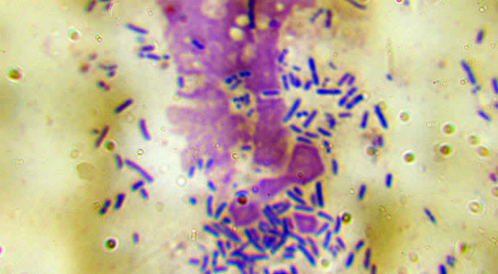 Pseudomonas rod shaped bacteria responsible for severe purulent otitis